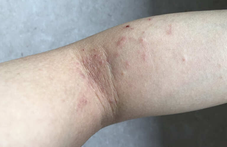 アトピー性皮膚炎の皮膚のかゆみを改善｜城東区の鍼灸院は難治性疾患対応の南川治療院鍼灸聚英堂